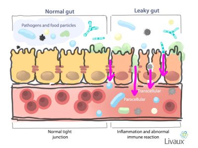 Inflammation and leaky gut - Livaux®
